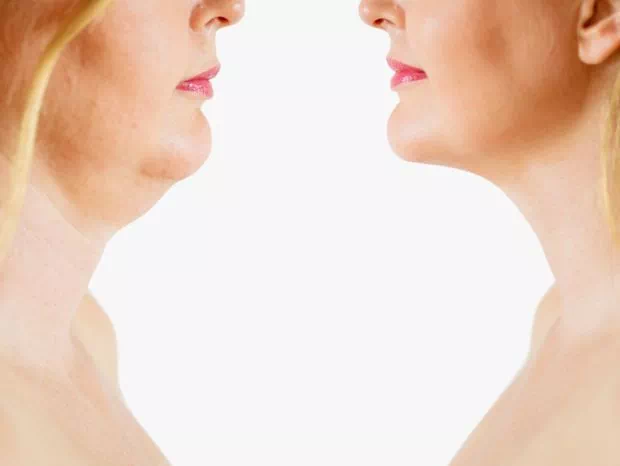 porównanie skóry szyi przed i po zabiegu